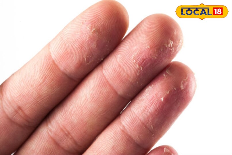 हथेली में अपरस