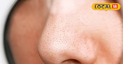 घर पर इन चीजो से ब्लैक हेड होगा खत्म, जानें यहाँ