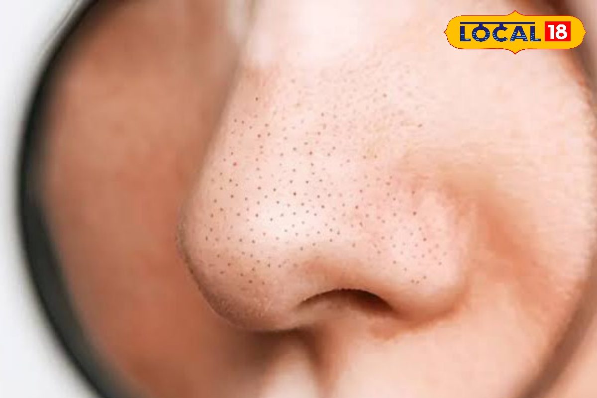 नाक के ब्लैकहेड्स को हटाने का नेचुरल तरीका, घर पर आसानी से हटेंगे काले धब्बे