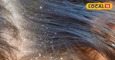 डेंड्रफ की समस्या।