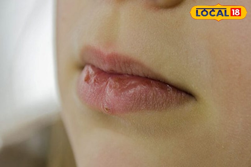 chapped lips in winter