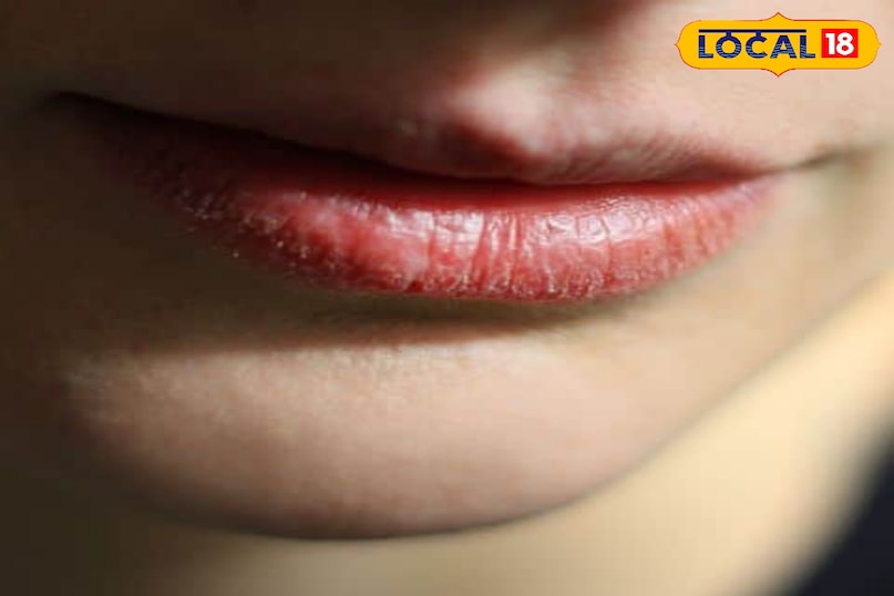 chapped lips in winter