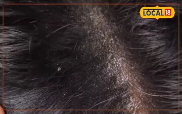 बालों में डैंड्रफ से पाएं छुटकारा 