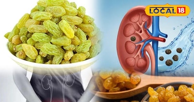 किडनी स्टोन