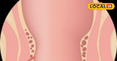  बिना किसी सर्जरी के फ़िस्टुला का इलाज संभव