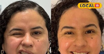 बेल्स पाल्सी में चेहरे की नसें काम करना बंद कर देती है जिससे यह तिरछा हो जाता है