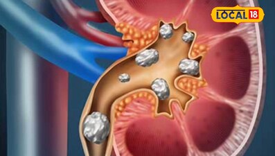 किडनी स्टोन का देसी इलाज- बस्तर के खेतों में मिला ‘महाकाल कांदा’, 15 दिन में राह
