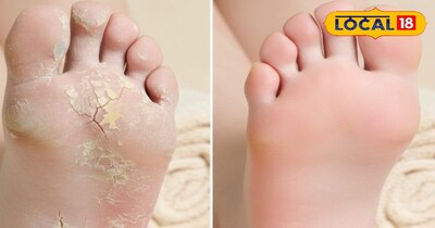 फटी एडियां, घरेलू उपाय 