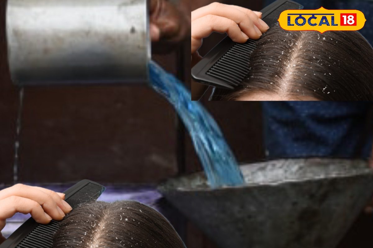 बालों में हो गया है डैंड्रफ तो करें ये घरेलू उपाय..10 दिन में मिल जाएगी निजात