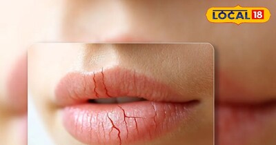 ठंड के मौसम में होंठों का फटना रोकने के देसी उपाय 