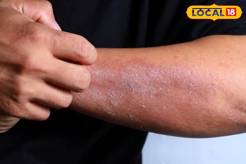 त्वचा रोग त्वचा रोग