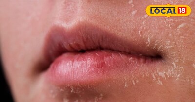 सर्दियों मे चेहरे मे सफ़ेद पपड़ी 