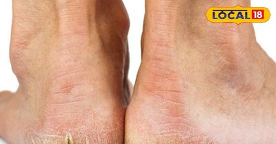 फटी हुई एड़ी 