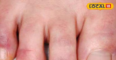 इस तरीके से सूज जाती है पांव की उंगलिया 