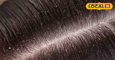 सर मे जुवें और डैंड्रफ की समस्या 