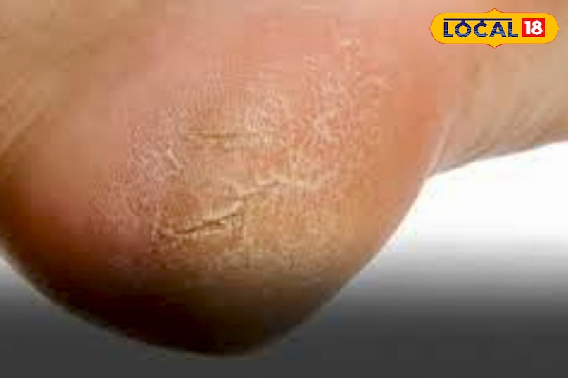 उन्होंने कहा कि एड़ियों को साफ रखने के लिए गुनगुने पानी में पैरों को 10 मिनट भिगोना फायदेमंद होता है. इसके बाद हल्के प्यूमिक स्टोन या फुट फाइल से मृत त्वचा को धीरे-धीरे हटाएं. ध्यान रहे, ज़्यादा रगड़ने से त्वचा को नुकसान पहुंच सकता है.