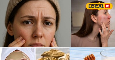 चेहरा का काला होना