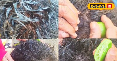 ग्रामीण नुस्खा बना डैंड्रफ का दुश्मन