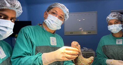 नेपाल की महिला के पेट से 1.5 किलोग्राम बालों का गुच्छा निकाला गया.