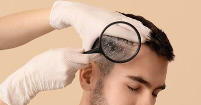 डैंड्रफ से छुटकारा पाने के उपाय.