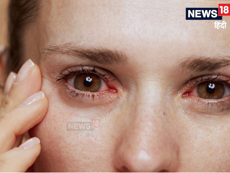 पॉल्यूशन में आंखों में हो रही जलन, खुजली, आंखों से पानी आना और लाल होने की परेशानी में आपको सीधे डॉक्टर के पास जाने की जरूरत नहीं है. आप घर पर रहकर भी इस बीमारी को ठीक कर सकते हैं. इसके लिए आपको स्टेरॉइड फ्री आई ड्रॉप बाजार से खरीदकर आंख में डाल सकते हैं और इस परेशानी से छुटकारा पा सकते हैं. 