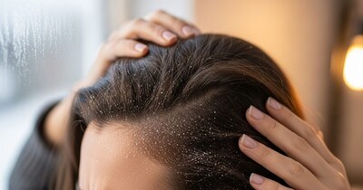 How To Remove Dandruff In Winter
