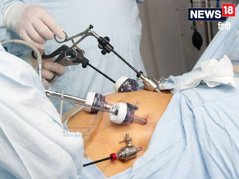 पेट और आंतों की इस सर्जरी से मोटापा और डायबिटीज दोनों ही ठीक होते हैं. पेट और आंतों की इस सर्जरी से मोटापा और डायबिटीज दोनों ही ठीक होते हैं.