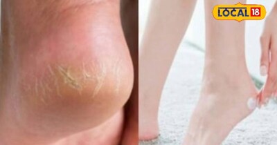 फटी एड़ियां