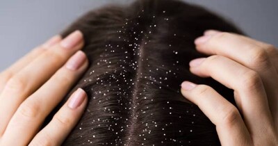 सर्दियों में डैंड्रफ से पाएं छुटकारा! आजमाएं ये घरेलू नुस्खे.