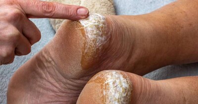 सर्दियों में फटी एड़ियों से पाएं छुटकारा: मोम और तेल का ये नुस्खा बनाएगा पैर मुलायम.