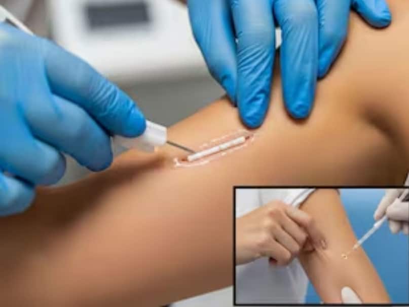 গুরুত্বপূর্ণ বৈশিষ্ট্য এবং সুবিধাগুলি একবার আপনি বাসওয়ালে ইমপ্লান্ট করার পরে, আপনি 3 বছরের জন্য গর্ভনিরোধক বড়ি বা অন্য কোনও উপায়ের প্রয়োজন অনুভব করবেন না। যদি একজন মহিলা 3 বছরের মধ্যে গর্ভবতী হন, তবে তিনি যে কোনও সময় ডাক্তারের কাছে যেতে পারেন এবং ইমপ্লান্টটি অপসারণ করতে পারেন। অপসারণের পর, কিছু দিনের মধ্যে স্বাভাবিকভাবে গর্ভধারণের ক্ষমতা ফিরে আসে। গোপনাঙ্গে কোনো কাটা নেই, তা কপার-টি-এর মতো, জরায়ুতে কোনো খরচ নেই, সংক্রমণ বা শারীরিক আঘাতের কোনো আশঙ্কা নেই।