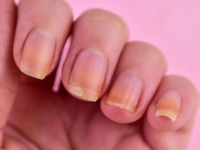 শরীরের অন্দরের প্রতিফলন দেখা যায় দেহের বাইরে থাকা অঙ্গ-প্রত্যঙ্গ। চিকিৎসকরা ‘বিশেষ লক্ষণ’ বা ‘সিম্পটম্পস’ দেখে বুঝে নিতে পারেন দেহের ভিতরে বাসা বেঁধেছে কোন কোন রোগ। বিশেষজ্ঞদের মতে, মানুষের নখ দেখে বোঝা যায় ‘আয়ু’।