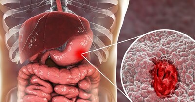 अल्सर के मरीज अपनाएं सही डाइट, पेट के घाव भरेंगे तेजी से.