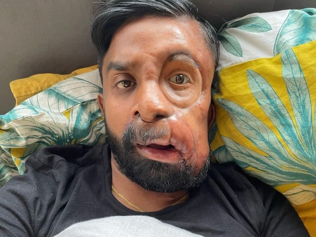 अजीब चेहरे के साथ पैदा हुआ शख्स, 26 बार हुई सर्जरी, देखें लोग ऐसी बातें करते हैं!