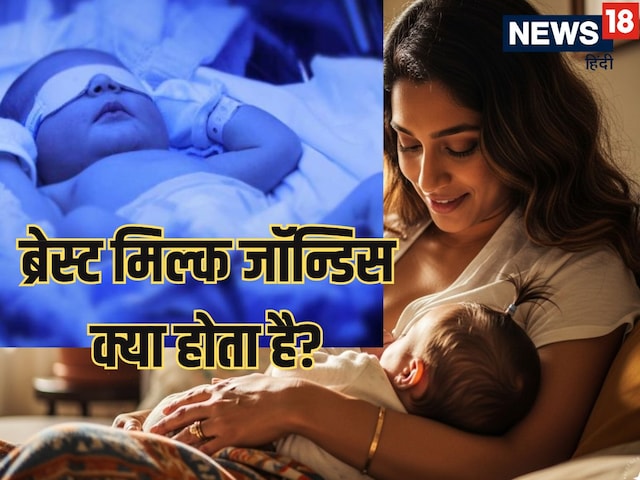 Does mother's milk cause jaundice in a newborn baby? understand with doctor