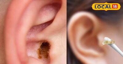 बिना हाथ लगाएं इस विधि से अपने कानों से निकाले मैल