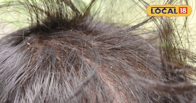 बालों में रूसी 