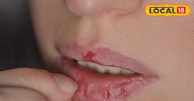 रूखे होठ 