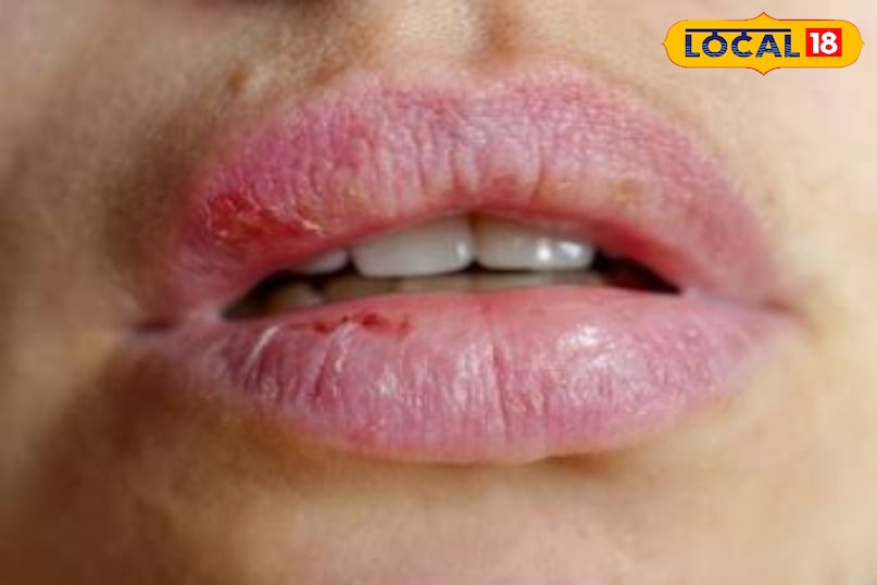 रूखे होठ 