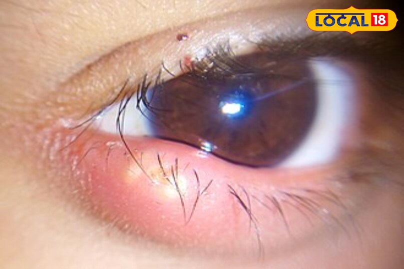 eye stye home remedies