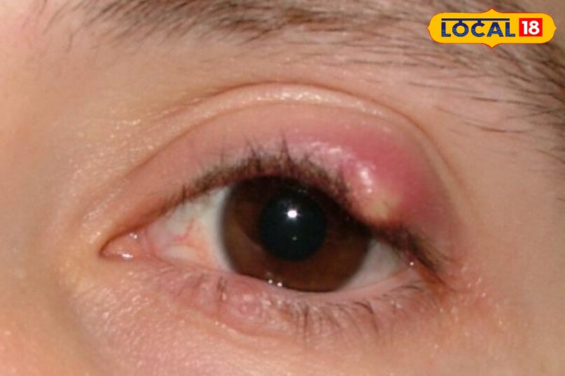 eye stye home remedies