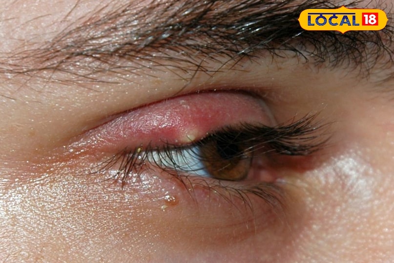 eye stye home remedies