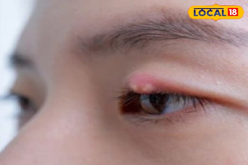 eye stye home remedies