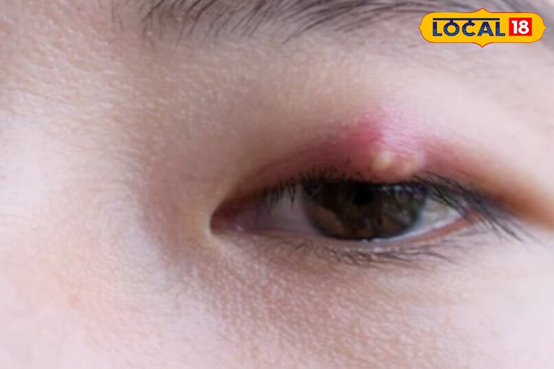 eye stye home remedies