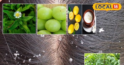 Hair Dandruff Tips