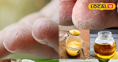 फ़टी एड़ियां