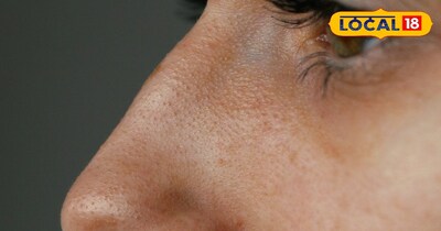 ब्लैकहेड्स