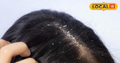 बाल से डैंड्रफ का 100% छुटकारा!