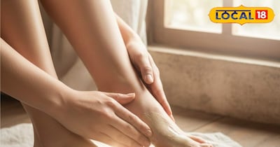 फटी एड़ियों के लिए आसान त्रिफला घृत उपाय.