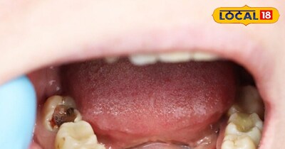 दांतों में कीड़ा 